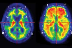 ¿Podría un análisis de sangre predecir si alguien tendrá Alzheimer?