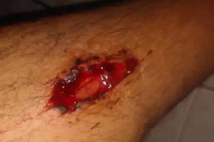 El joven herido durante una pelea, en Tucumán