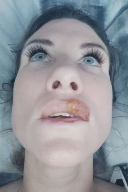 El labio comenzaba a hincharse y luego, en un momento de intenso padecimiento, se abría, lo que era "algo asqueroso y doloroso", según la propia Palmer