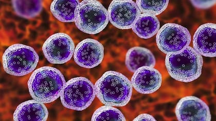 El linfoma de Hodgkin es un tipo de cáncer que ataca de forma directa los glóbulos blancos denominados linfocitos