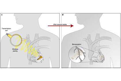 El marcapasos temporal desarrollado por los investigadores de la Universidad Northwestern y George Washington utiliza un sistema de energía por ondas de radio