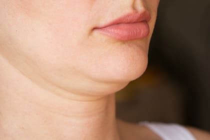 El médico sostuvo que también existe un componente genético a la hora de presentar esta característica física
