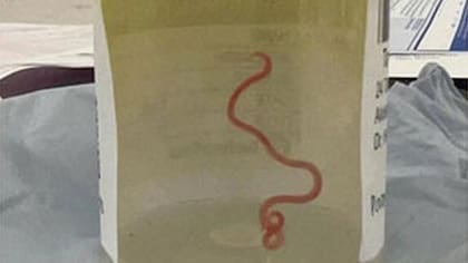 El nematodo extraído del cerebro de una mujer