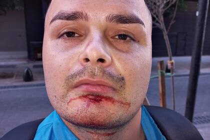 El oficial Cristofer Ibarrola recibió un golpe de puño en el rostro