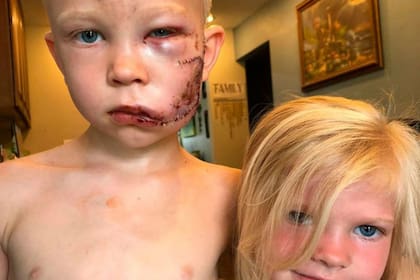 El pequeño Bridger se convirtió en héroe ayer cuando recibió el ataque de un perro que iba a morder a su hermana y terminó herido y con 90 puntos de sutura en la cara