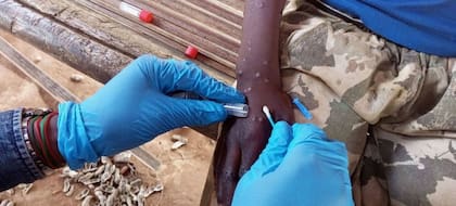 El período de incubación de la Mpox suele ser de entre 6 a 13 días.