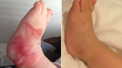 El pie de un bebé que sufrió una quemadura, luego de 30 días de aplicar Cicaplast