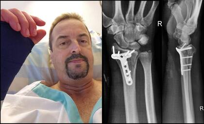 El primer vuelo en ala delta de Gurksy terminó con una cirugía y una placa de titanio con clavos en su muñeca.