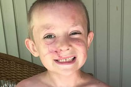 El proceso de cicatrización de todas las heridas del rostro de Camdon llevó varios meses, y todavía quedan marcas