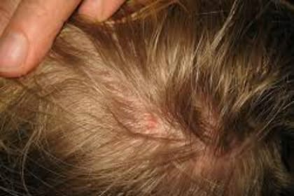 El rascado produce heridas cutáneas que pueden infectarse