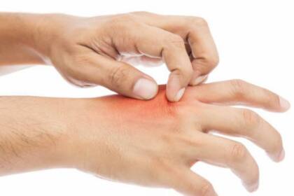 El rechazo a las personas que sufren picazón