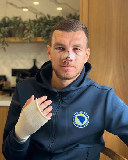 El rostro de Dzeko tras la patada: su nariz inflamada y la ceja cortada