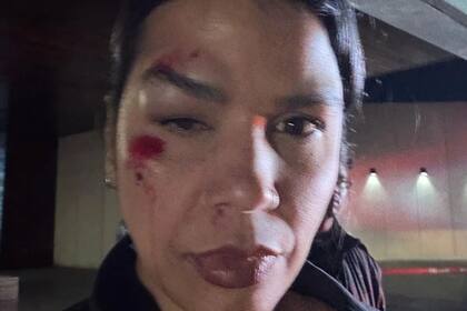 El rostro de Fonseca previo a ingresar al hospital para atender sus heridas (Telemundo Houston)