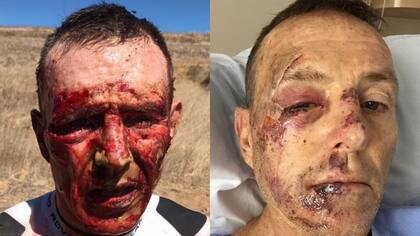 El rostro de Joel Stransky apenas sufrió el accidente con su bicicleta y durante su internación
