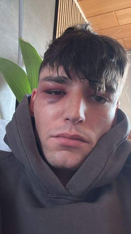 El rostro desfigurado de Pascal Kaiser tras recibir una golpiza en la vía pública