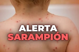 Un especialista advirtió que investigan si ingreso al país una nueva variante de sarampión