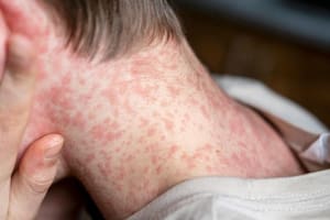 Un experto analizó el alerta sanitaria por sarampión y reveló “la única manera” para evitar una epidemia en el país