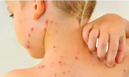 El sarampión es una enfermedad viral altamente contagiosa que puede provocar complicaciones graves, como neumonía y encefalitis, y en algunos casos, la muerte