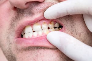 El sarro dental puede eliminarse gracias a una infusión que funciona como aliado natural