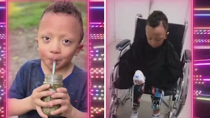 El síndrome de Noonan rasopatía es causada por mutaciones en genes que afectan la vía “RAS-MAPK”