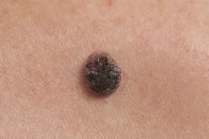 Nuevos tratamientos contra el cáncer de piel más agresivo: consejos para detectarlo a tiempo