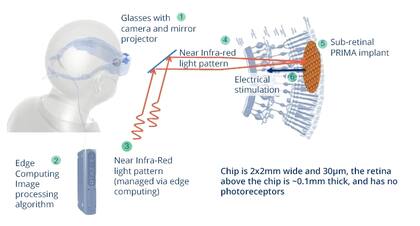 El sistema Prima desarrollado por Pixium; los anteojos tienen una cámara que está unida a una computadora, que procesa la información y la reenvía a un chip en la retina del paciente
