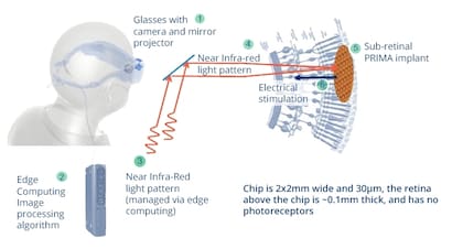 El sistema Prima desarrollado por Pixium; los anteojos tienen una cámara que está unida a una computadora, que procesa la información y la reenvía a un chip en la retina del paciente