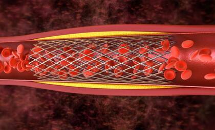 El stent es un tubo de malla abierta que, una vez insertado, expande el vaso sanguíneo, manteniéndolo abierto para restablecer el flujo sanguíneo normal