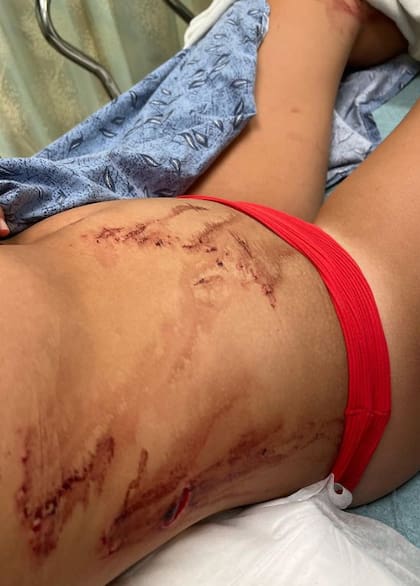 El tiburón se acercó a la chica y mordió su estómago, luego le provocó heridas en un brazo, dedo y rodilla