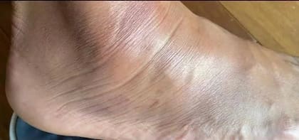 El tobillo lesionado de Carlos Tevez, luego del Superclásico por la Copa de la Liga Profesional de Fútbol