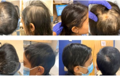 El tratamiento con baricitinib trajo buenos resultados (Foto: medicaldialogues.in)