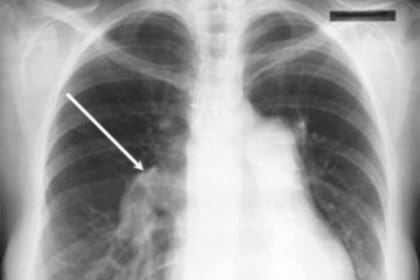 El tratamiento es muy costoso y carece de una cobertura adecuada