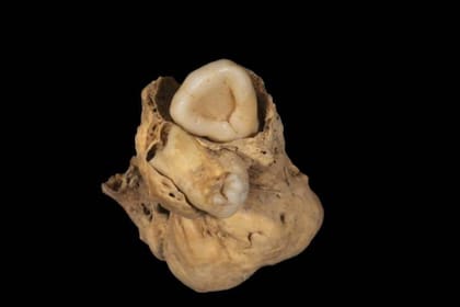 El tumor encontrado en la pelvis del esqueleto de una joven en Amarna, Egipto, era un teratoma de ovario, y contaba con dientes