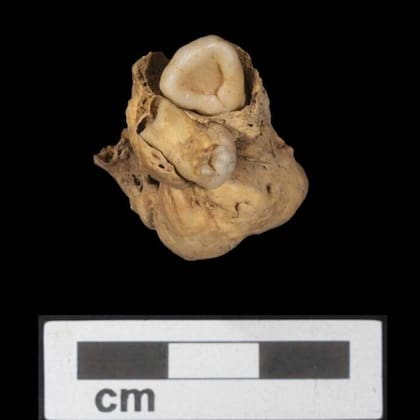 El tumor hallado en la tumba de Amarna, Egipto, es un teratoma ovárico o tumor de células germinales, que se caracteriza por contar con huesos, dientes, o pelo