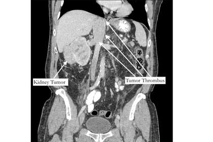 El tumor maligno que se había alojado en el riñón