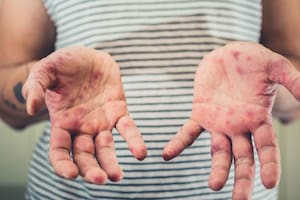 El virus con más capacidad de diseminación es el sarampión. Crédito: Carmeloportal