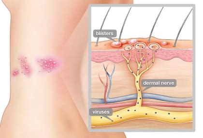El virus, cuando se reactiva, viaja por un nervio de nuestro sistema y de esa manera llega a la piel.
