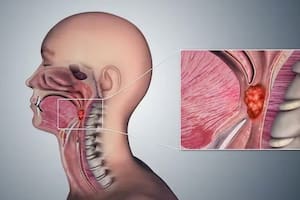 Cáncer de garganta: la práctica que realiza el 80% de los adultos y puede ser un factor de riesgo