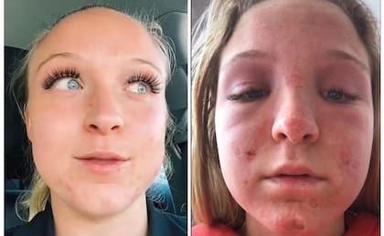 Emma Hoffström sufrió graves quemaduras en una cama solar