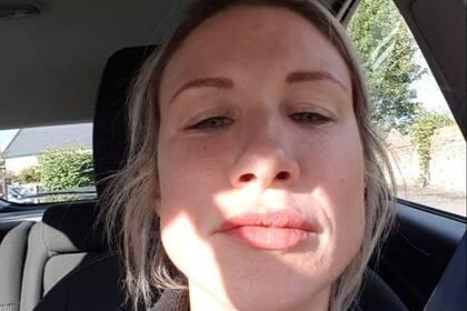Emma Palmer tiene 35 años y se aplicó en 2018 una dosis doble de relleno labial por el que todavía hoy continúa pagando las consecuencias