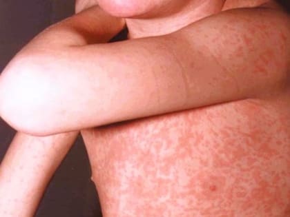 Empieza a calmar el ritmo de contagios en Florida