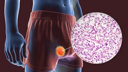 En 2020 a Dave le diagnosticaron cáncer de testículo