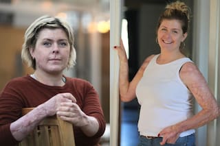 Una explosión la despertó y en la lucha por salvar a sus seis hijos terminó con el 93% de su cuerpo quemado