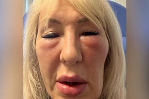 En diciembre de 2023, Andrea apenas podía abrir los ojos y sufría hinchazón alrededor de las mejillas después de recibir rellenos faciales en una clínica de cosmética en Hull, Reino Unido (Foto: Handout)