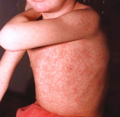 En la Argentina, el rebrote de sarampión volvió a estar en el centro de la escena