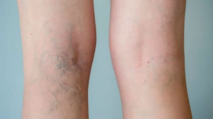 En la Argentina mueren 4300 personas cada año por esta afección