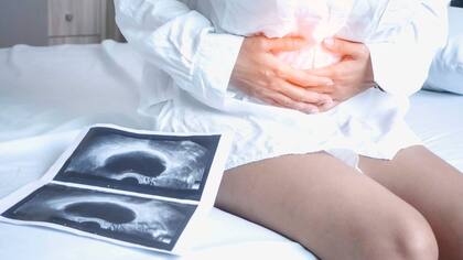 En la Argentina mueren cerca de 1200 mujeres por año por el cáncer de ovario 