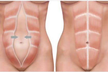 En la imagen de la izquierda se ve la diástasis abdominal; en la de la derecha, el músculo recto abdominal sin alteraciones
