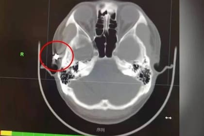 En la imagen de la resonancia magnética se puede observar el proyectil que le generaba el dolor de cabeza al joven.