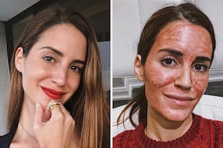 Cómo es el blood facial, el tratamiento preferido de Victoria Beckham y Kim Kardashian